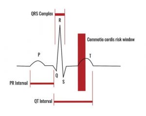 What Is Commotio Cordis And How Can It Affect Athletes? | AED.US BLOG